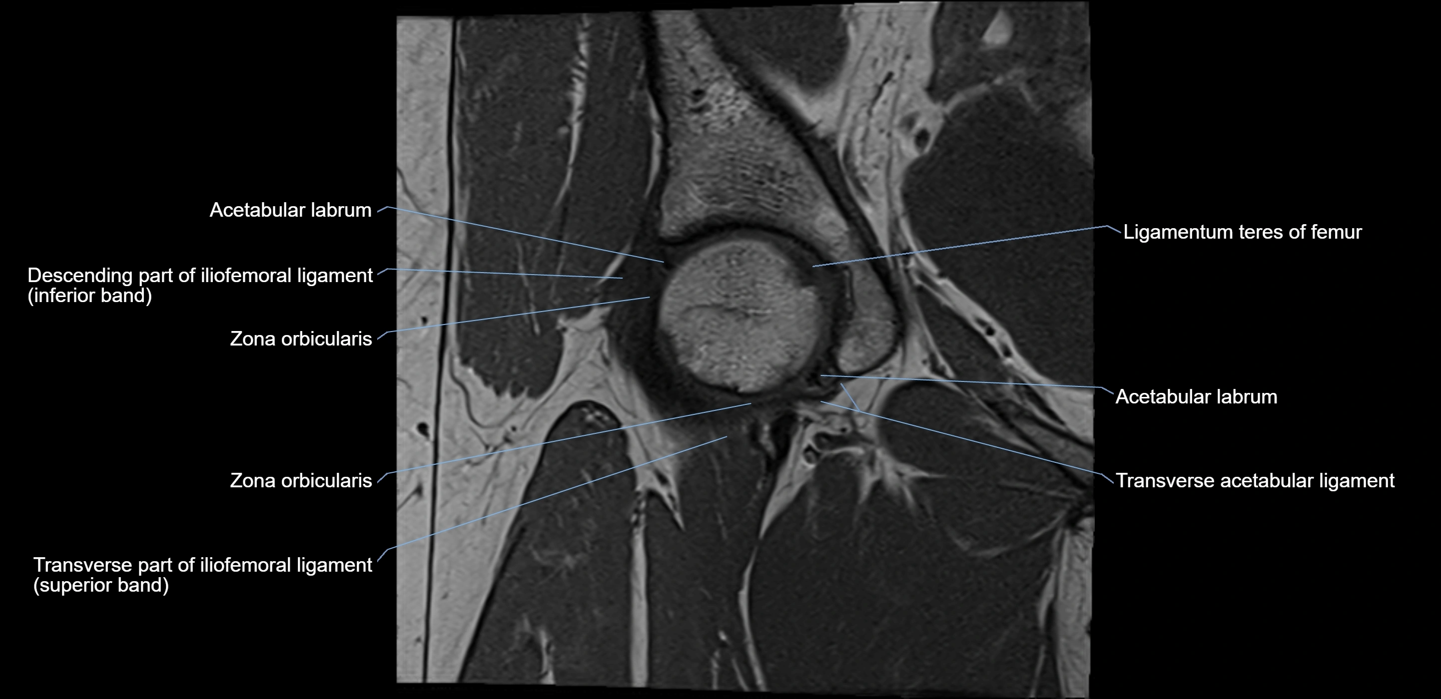 MRI Hip ligaments coronal cross sectional anatomy 3T  radiology  image-img-00001-00007.webp